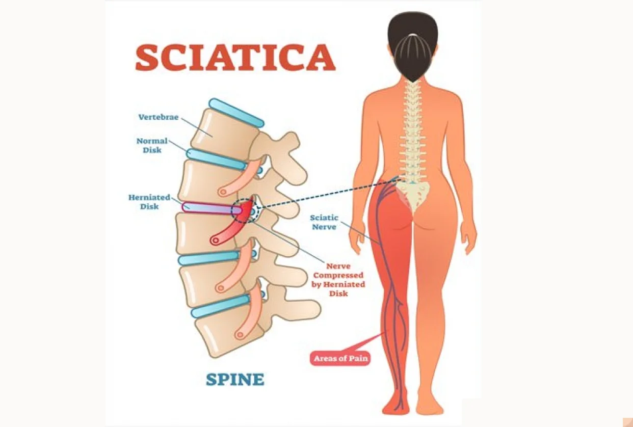 Sciatica