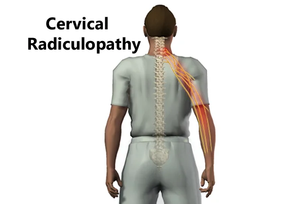 Cervical Radiculopathy
