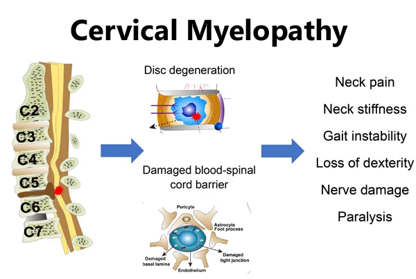 Cervical Myelopathy